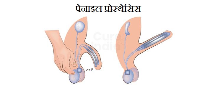 पेनाइल इंप्लांट सर्जरी के लाभ और लागत